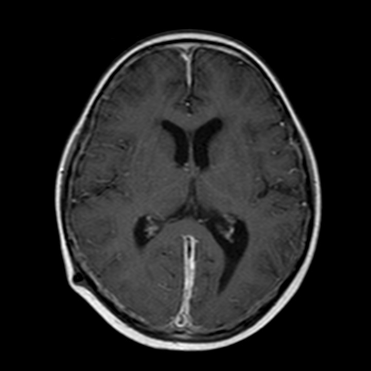 Leukemic meningitis | Image | Radiopaedia.org