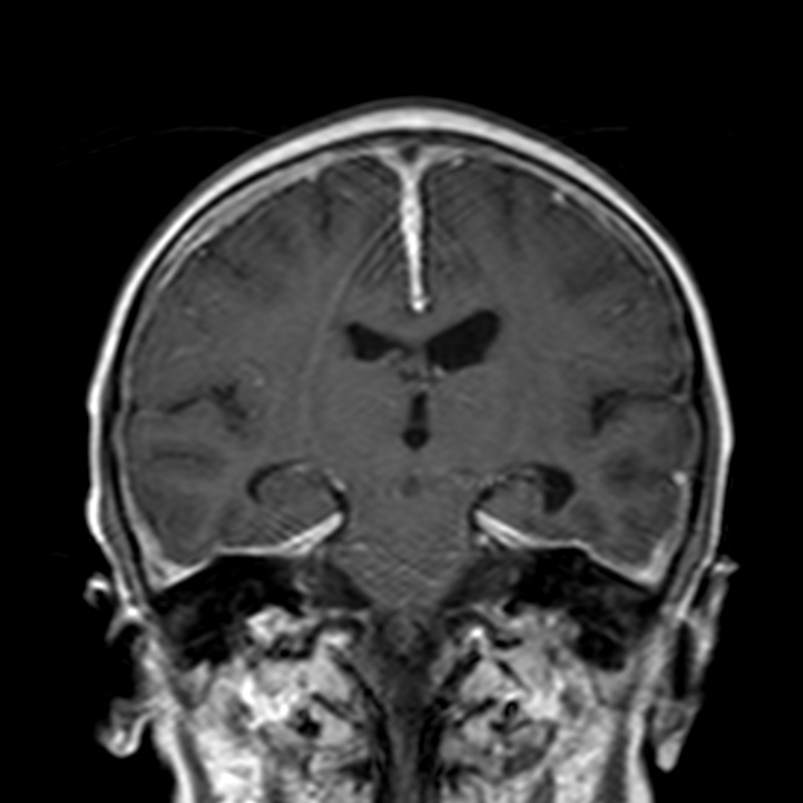 Leukemic meningitis | Image | Radiopaedia.org