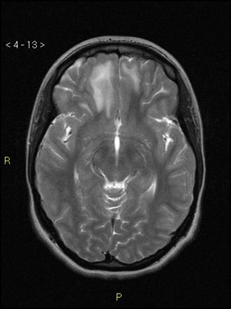 Contre coup injury with cerebral hemorrhagic contusion | Image ...