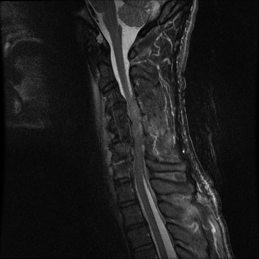 Discitis Osteomyelitis - Cervical Spine | Image | Radiopaedia.org