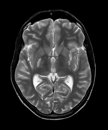 CNS tuberculosis | Radiology Case | Radiopaedia.org