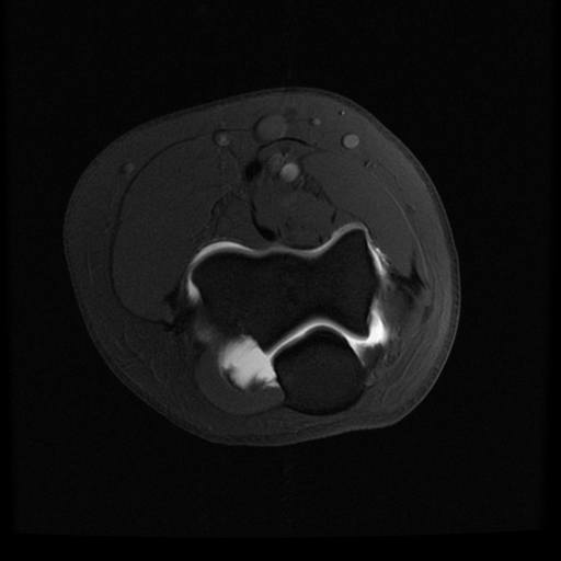 Normal elbow arthrogram | Image | Radiopaedia.org