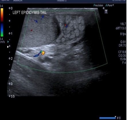 Varicocele thrombosis | Image | Radiopaedia.org