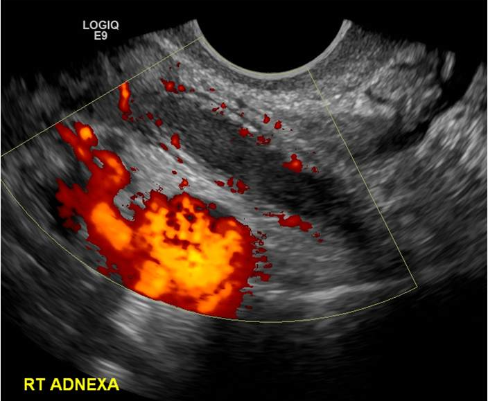 Узи аппендицита. Разрыв кисты яичника на УЗИ. Трансвагинальное УЗИ яичники.