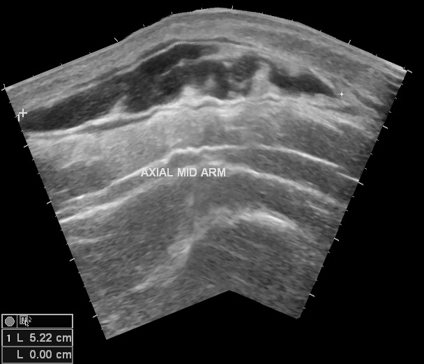 Giant Rectus Sheath Hematoma The Ultrasound Journal