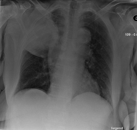 Lung cancer | Radiology Reference Article | Radiopaedia.org