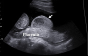 Preplacental abruption | Radiology Reference Article | Radiopaedia.org