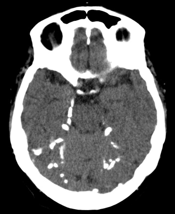 Normal intracranial calcifications | Radiology Reference Article ...