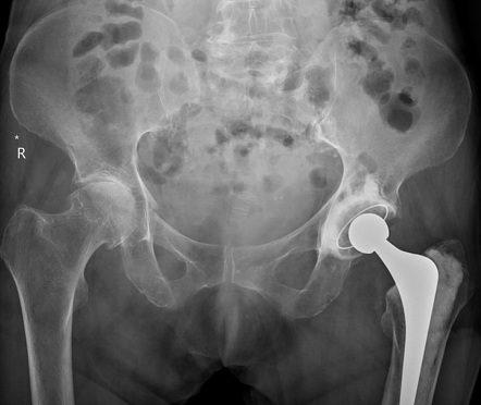 Right acetabular fracture | Radiology Case | Radiopaedia.org