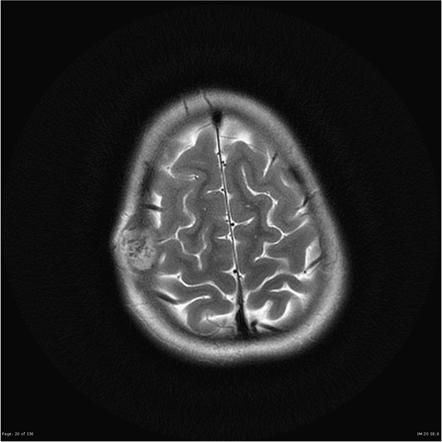 Eosinophilic granuloma - skull | Image | Radiopaedia.org