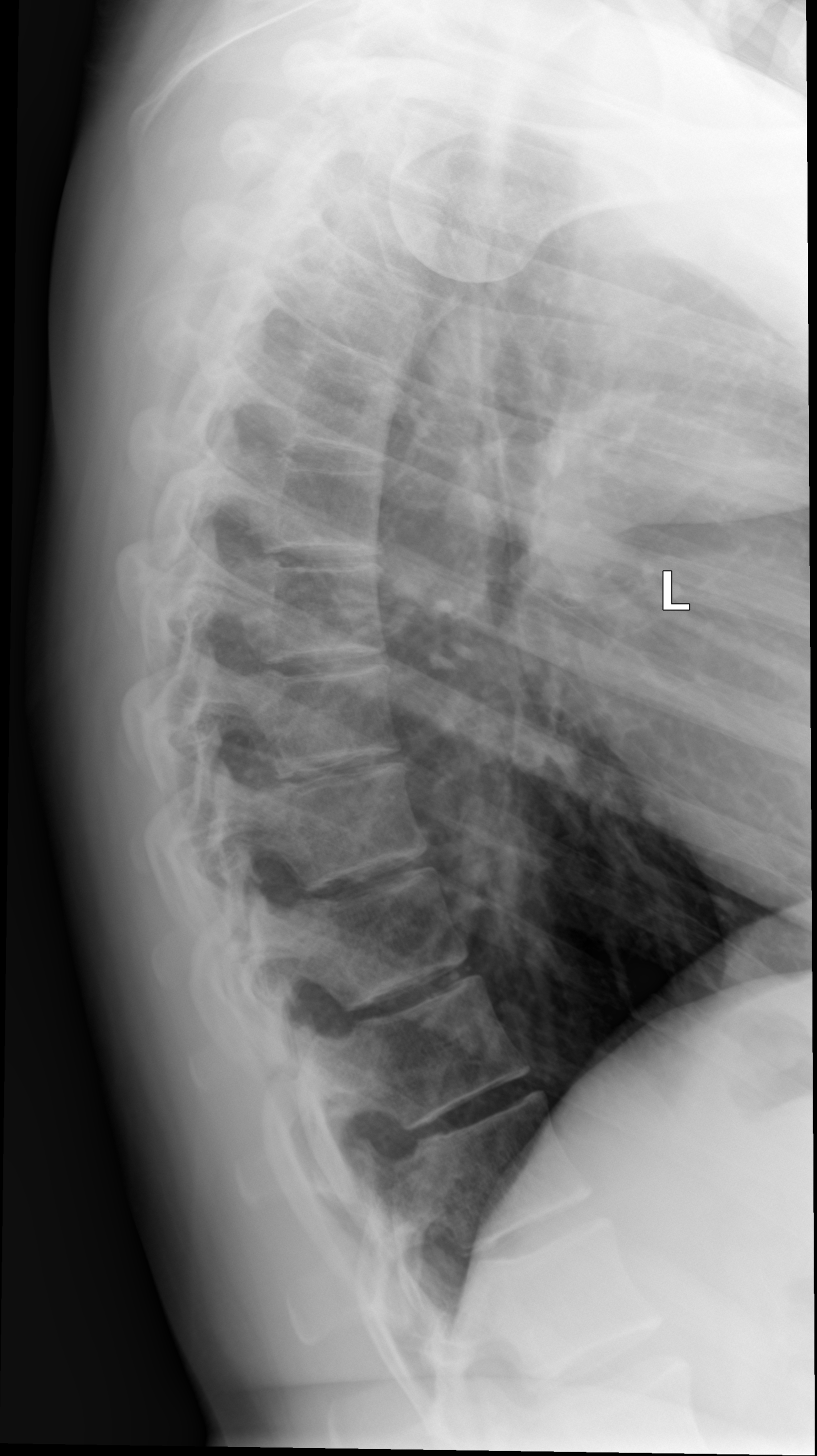 Normal thoracic spine | Image | Radiopaedia.org