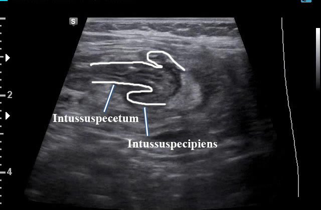 Imaging In Intussusception Sinaiem