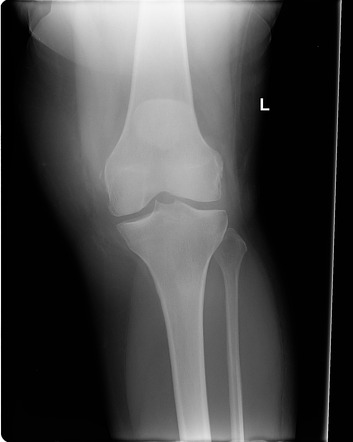 Patellar tendon rupture | Radiology Case | Radiopaedia.org