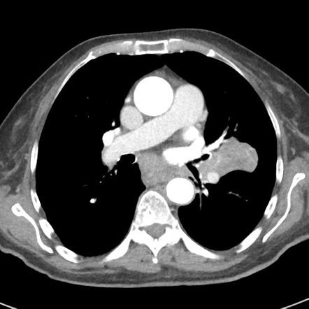 Lung cancer with left atrial thrombus | Radiology Case | Radiopaedia.org