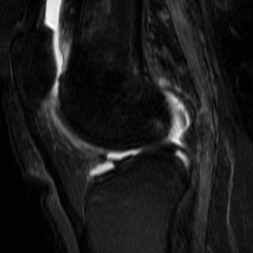 Traumatic chondral injury of the retropatellar knee joint | Image ...