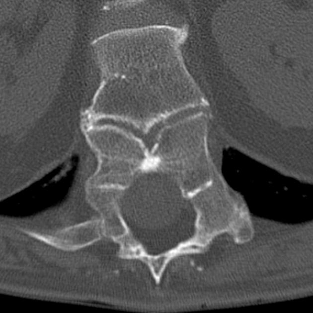 Butterfly vertebra | Radiology Reference Article | Radiopaedia.org