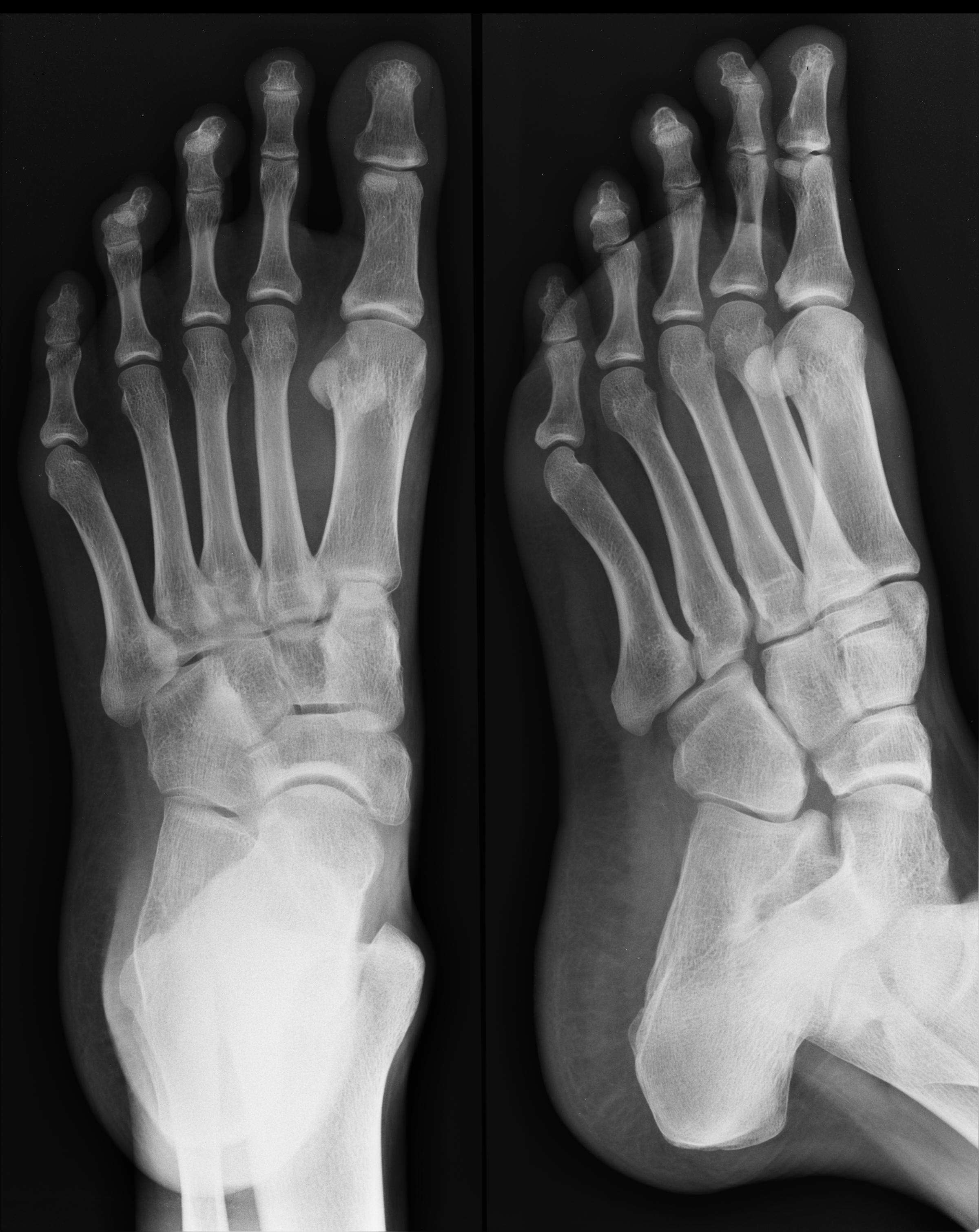 Foreign body in foot | Image | Radiopaedia.org