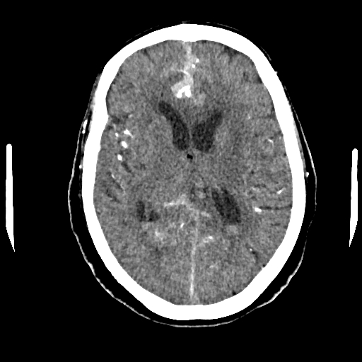 Aneurysmal Subarachnoid Hemorrhage Modified Fisher Grade 4 And