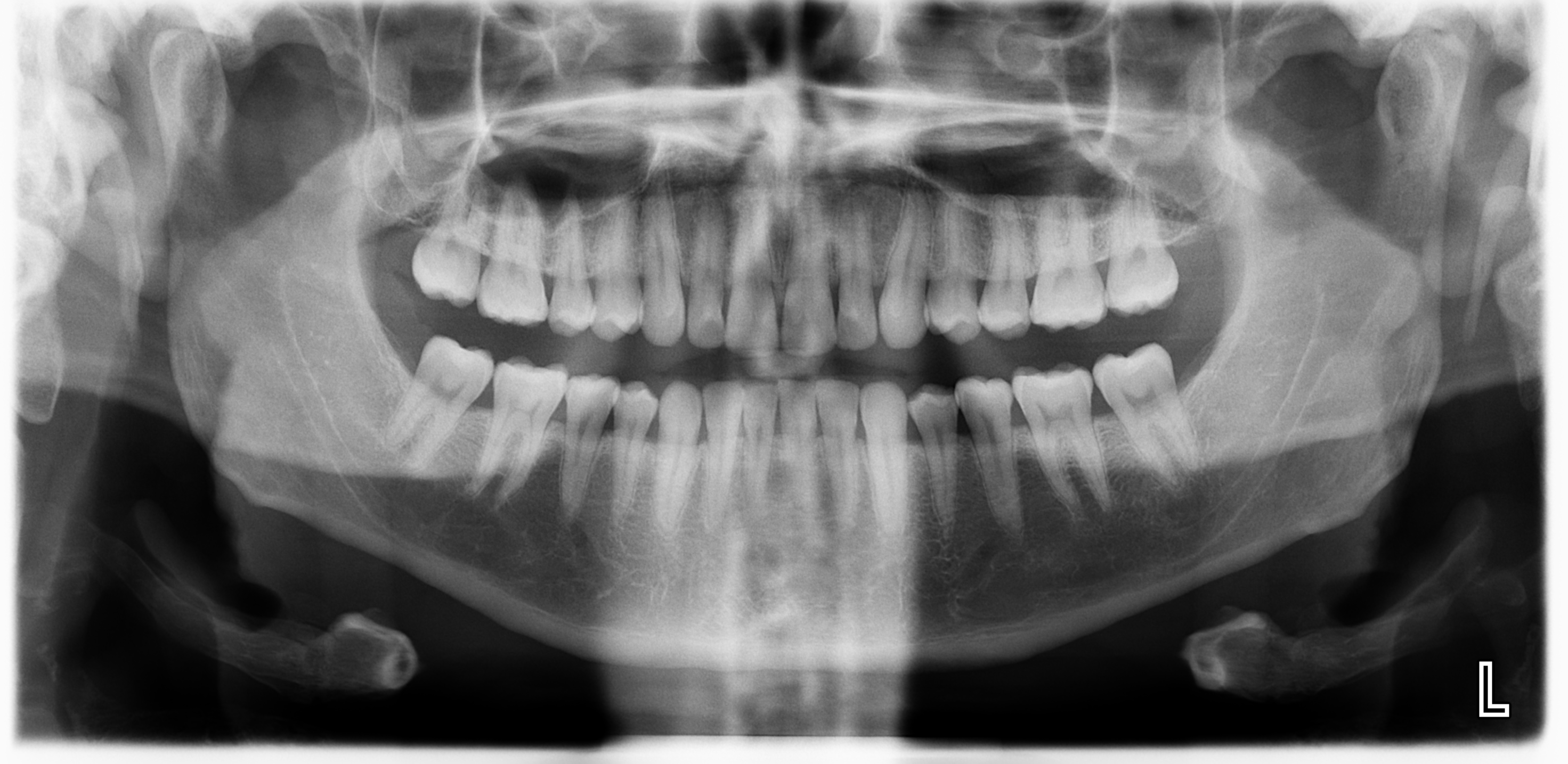 Normal OPG | Image | Radiopaedia.org