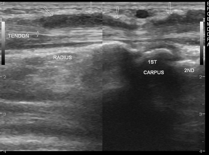 Extensor tenosynovitis of wrist | Image | Radiopaedia.org