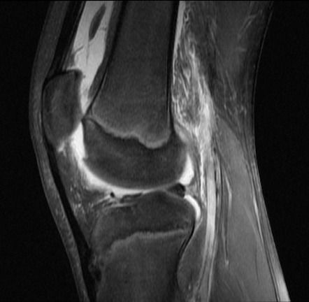 Chondral Fracture - Knee 