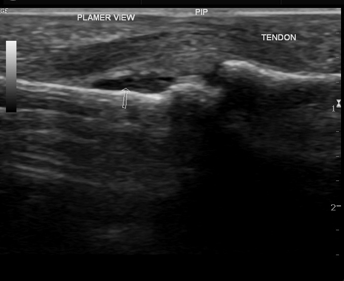 Foreign body induced synovitis - proximal interphalangeal joint | Image ...