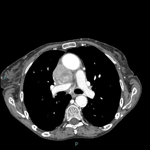 Thymoma with superior vena caval encasement | Image | Radiopaedia.org