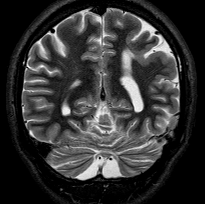 Schizencephaly | Image | Radiopaedia.org