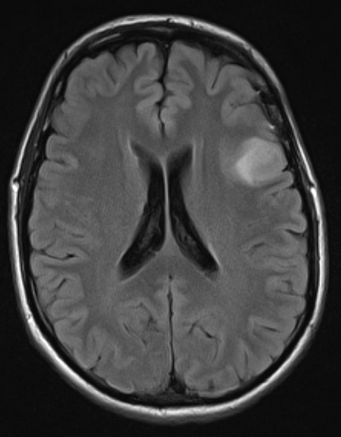 Глиома опухоль. Глиома Low Grade MRI. Глиома граде 1. Глиома ствола головного мозга у детей.