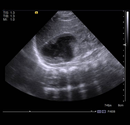 Neonatal adrenal hemorrhage | Radiology Case | Radiopaedia.org