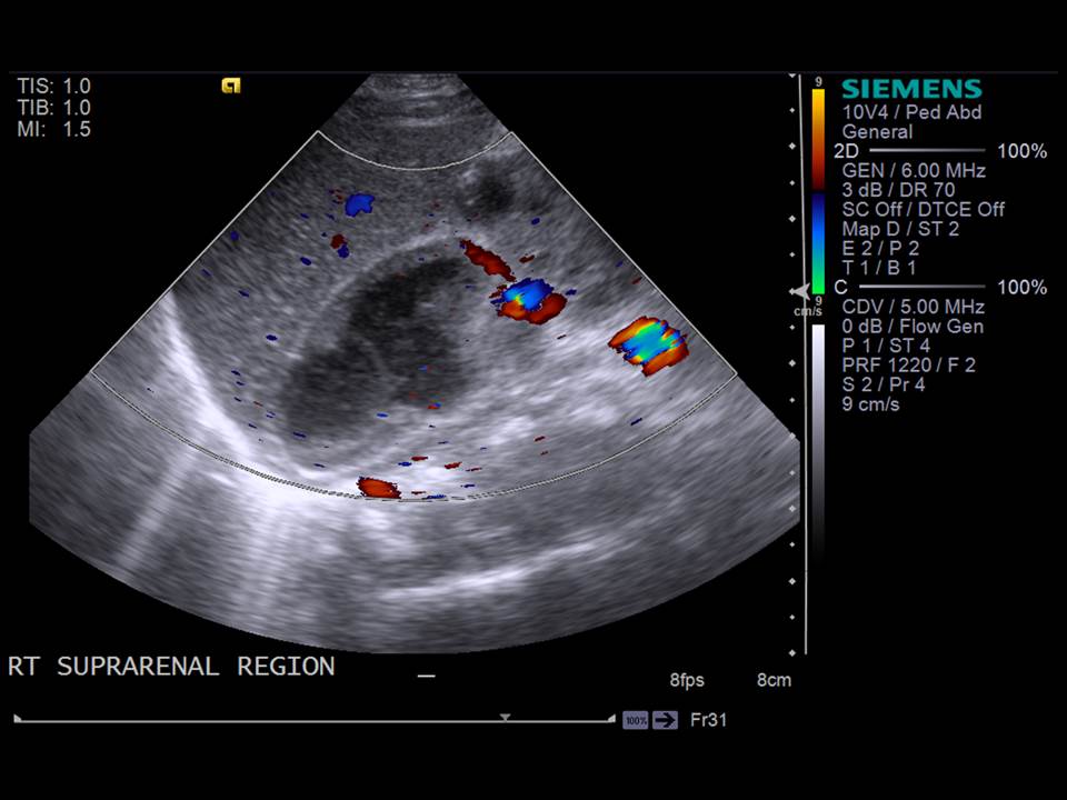 Узи надпочечников детям