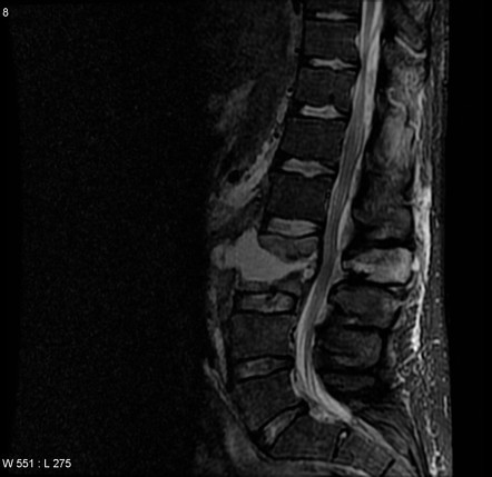 Advanced L2/3 Discitis-osteomyelitis | Image | Radiopaedia.org