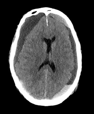 Bilateral Acute-on-chronic Subdural Haematomas 