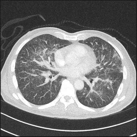 Viewing playlist: Locations of Swan Ganz catheters | Radiopaedia.org