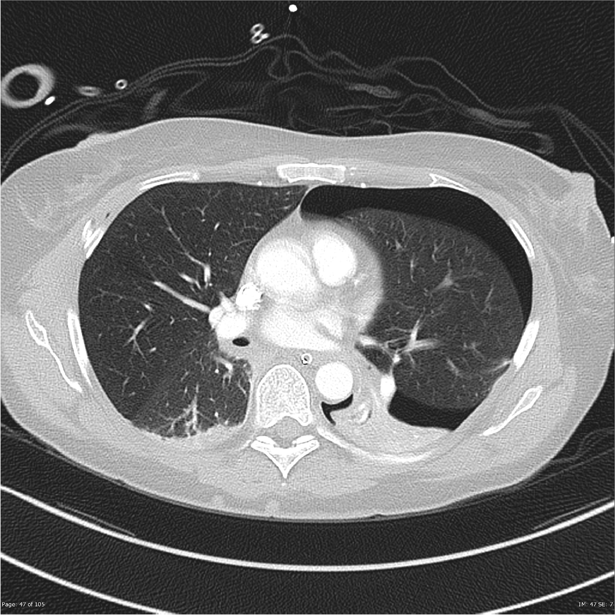 File:Fallen lung, pneumothorax, hepatic and pancreatic lacerations and ...