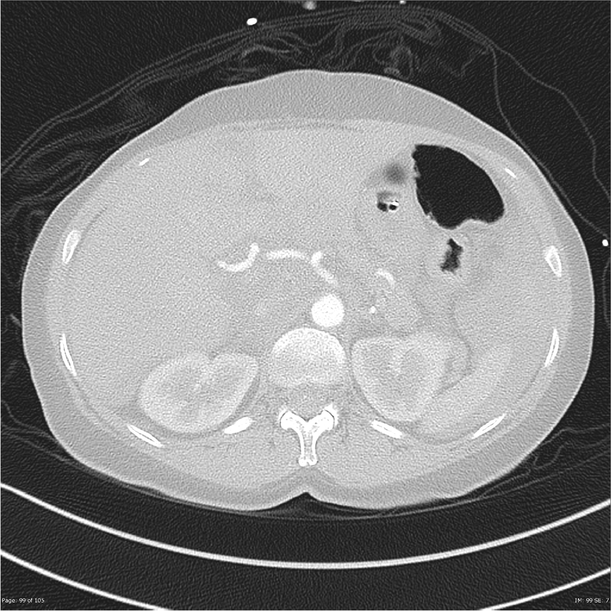 File:Fallen lung, pneumothorax, hepatic and pancreatic lacerations and ...