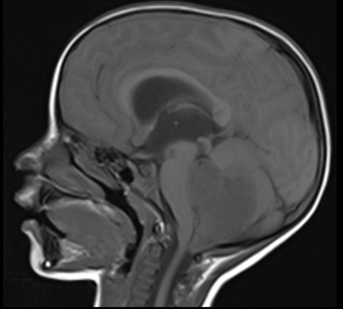 Medulloblastoma | Image | Radiopaedia.org