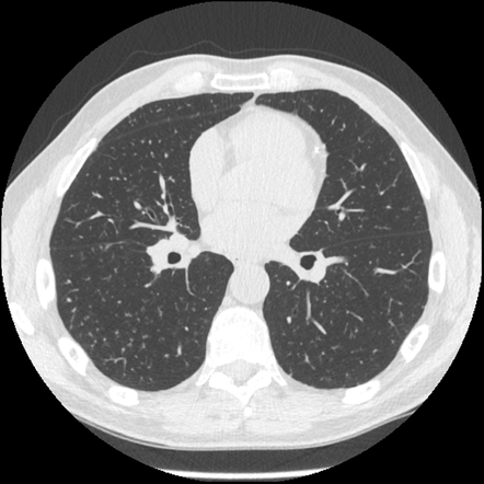 Simple silicosis | Image | Radiopaedia.org