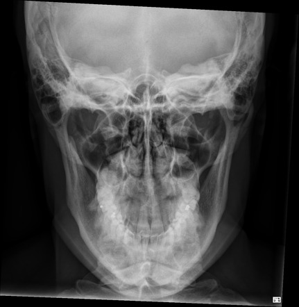 Normal mandible series | Radiology Case | Radiopaedia.org