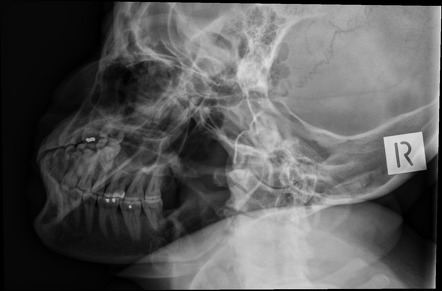 Normal Mandible Series Image Radiopaedia Org