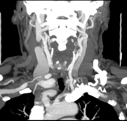 Carotid artery stenosis | Image | Radiopaedia.org