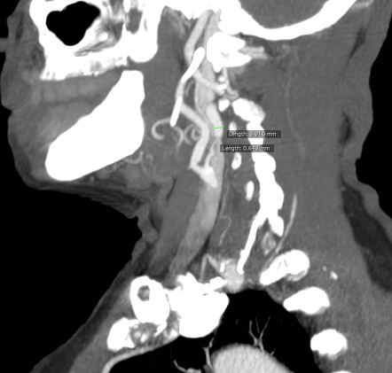 Carotid artery stenosis | Radiology Reference Article | Radiopaedia.org