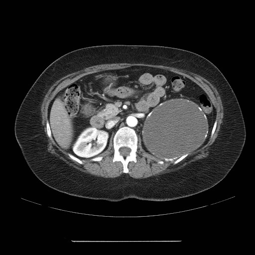 Cystic Adrenal Lymphangioma Image