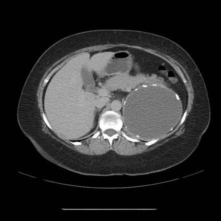 Cystic adrenal lymphangioma | Image | Radiopaedia.org