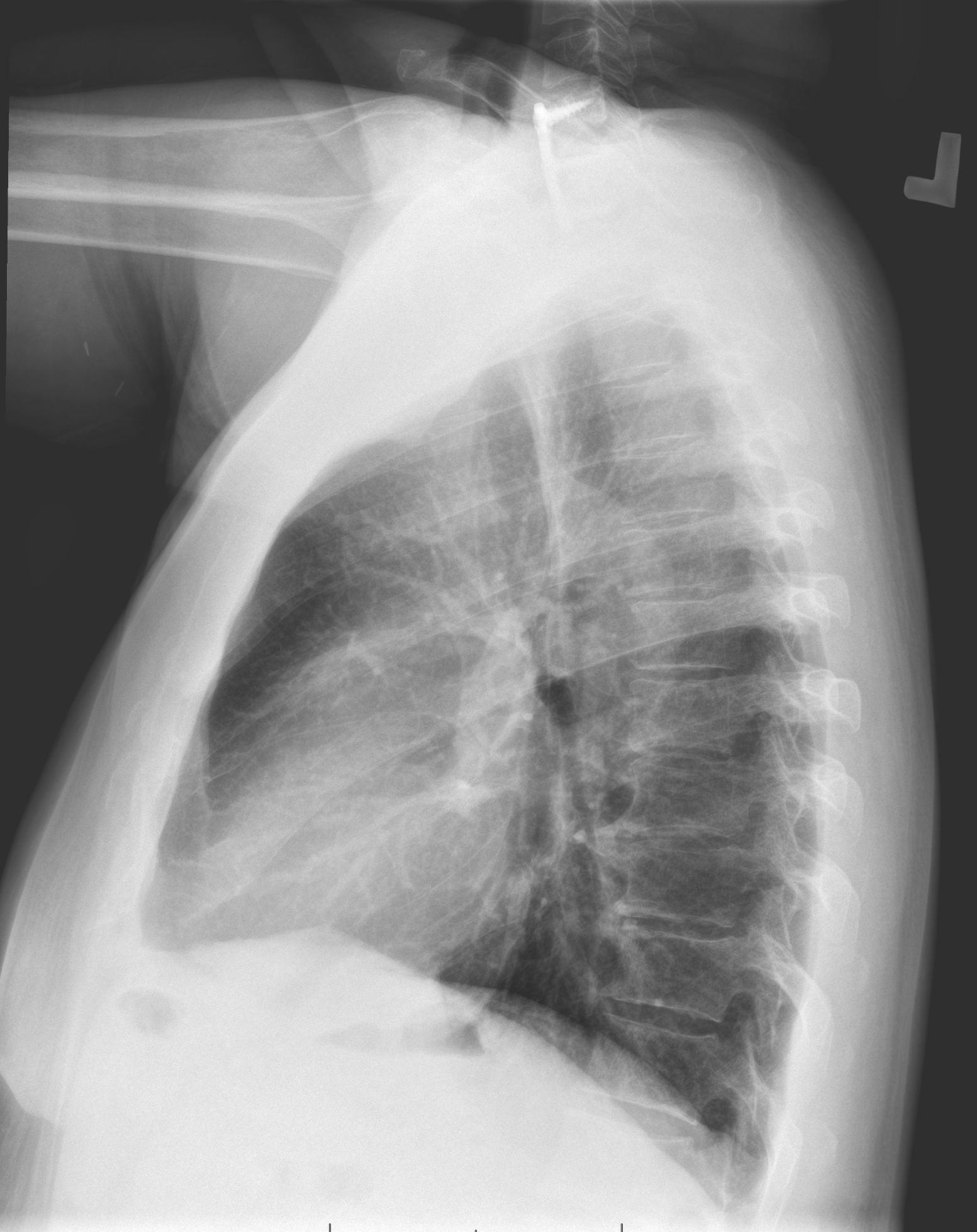 Mumford procedure | Image | Radiopaedia.org