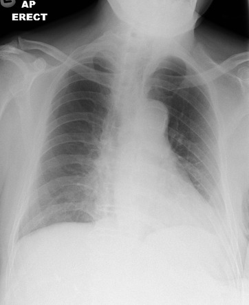 Artifactual hemithorax white-out and aortic knuckle calcification ...