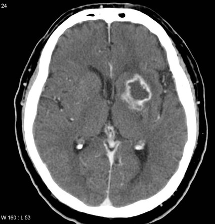 Subacute hemorrhagic stroke - enhancing | Radiology Case | Radiopaedia.org