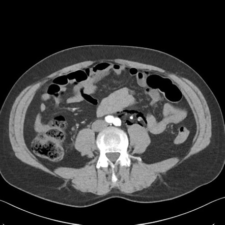 Perforated bleeding rectum secondary to ulcerative colitis | Image ...