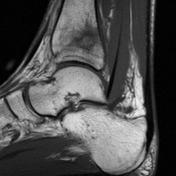 Stress fracture | Radiology Reference Article | Radiopaedia.org