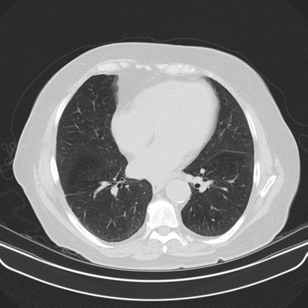 Minimally Invasive Adenocarcinoma Of The Lung | Radiology Case ...